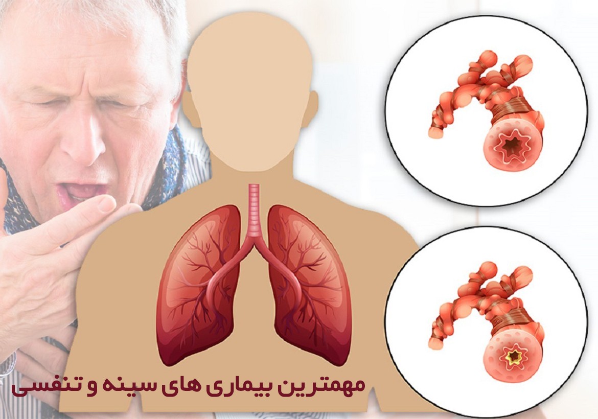 مهمترین بیماری های سینه و تنفسی 